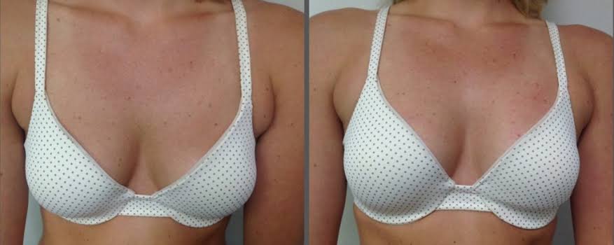 Vampire Breast Lift In Erie Pa Glow Laser And Beauty Center